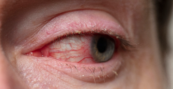 Pink eye